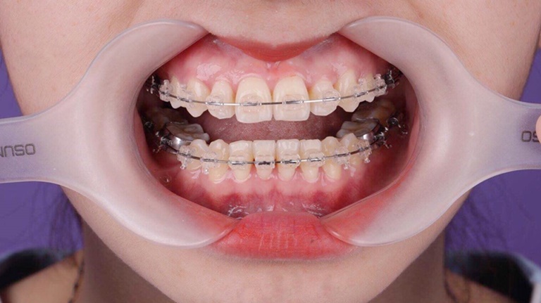 C&aacute;c Loại D&acirc;y Cung Niềng Răng D&ugrave;ng Nhiều Nhất Trong Chỉnh Nha