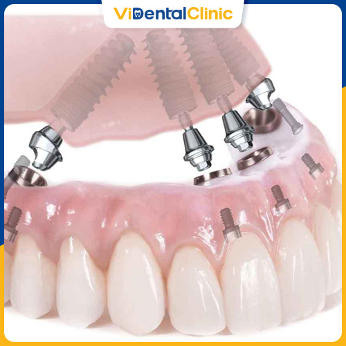 Trồng 2 Răng Li&ecirc;n Tiếp: Phương Ph&aacute;p Chi Ph&iacute; v&agrave; Lưu &Yacute; Quan Trọng