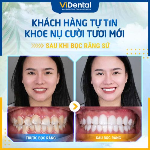 Bọc 6 Răng Sứ L&agrave; G&igrave;?