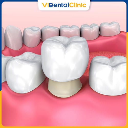 16 Tuổi Trồng Răng Được Kh&ocirc;ng? Chuy&ecirc;n Gia Giải Đ&aacute;p