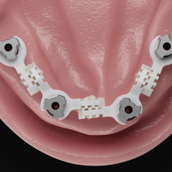 Straumann EXACT&trade; workflow