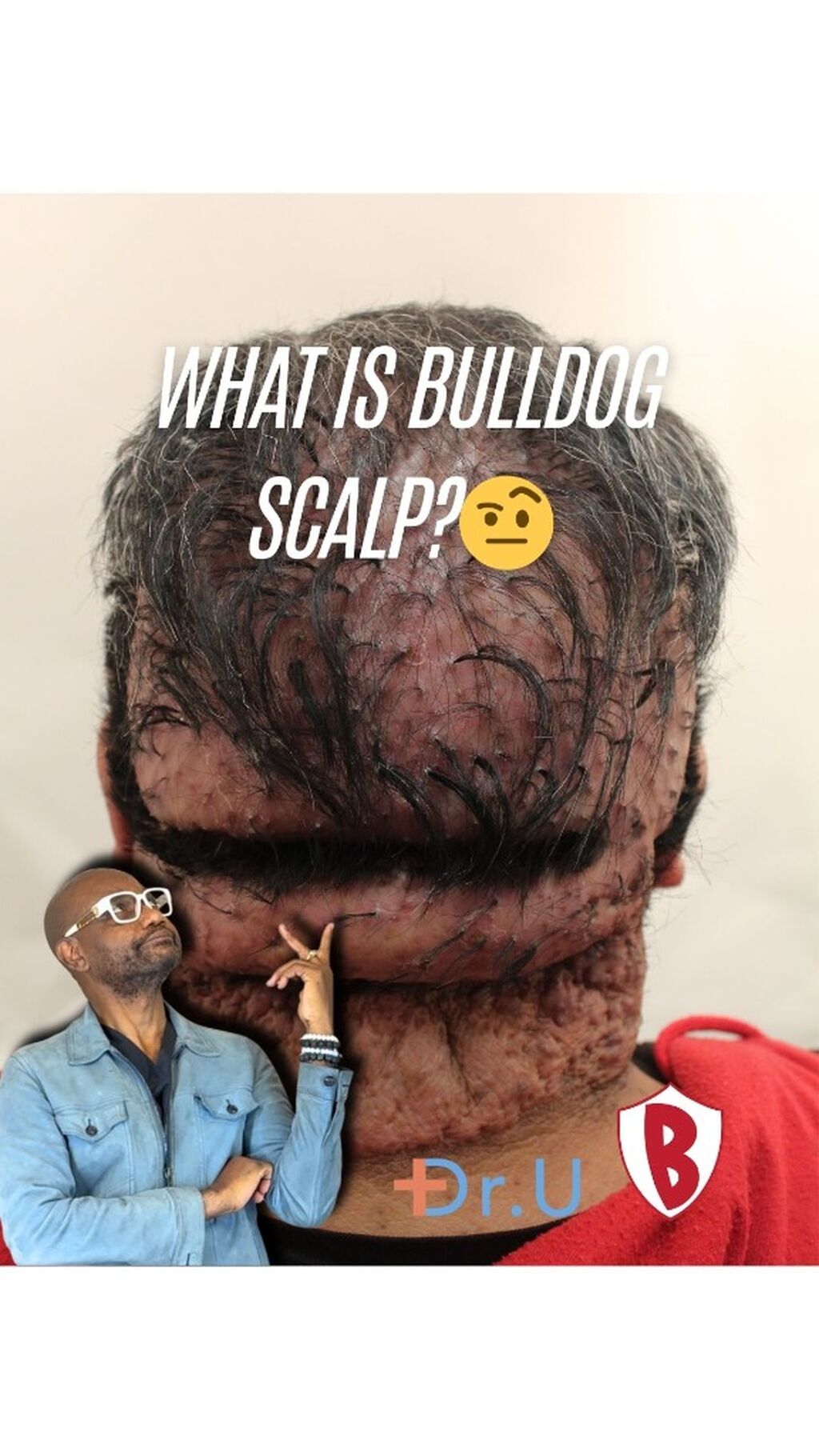 What is Bulldog Scalp