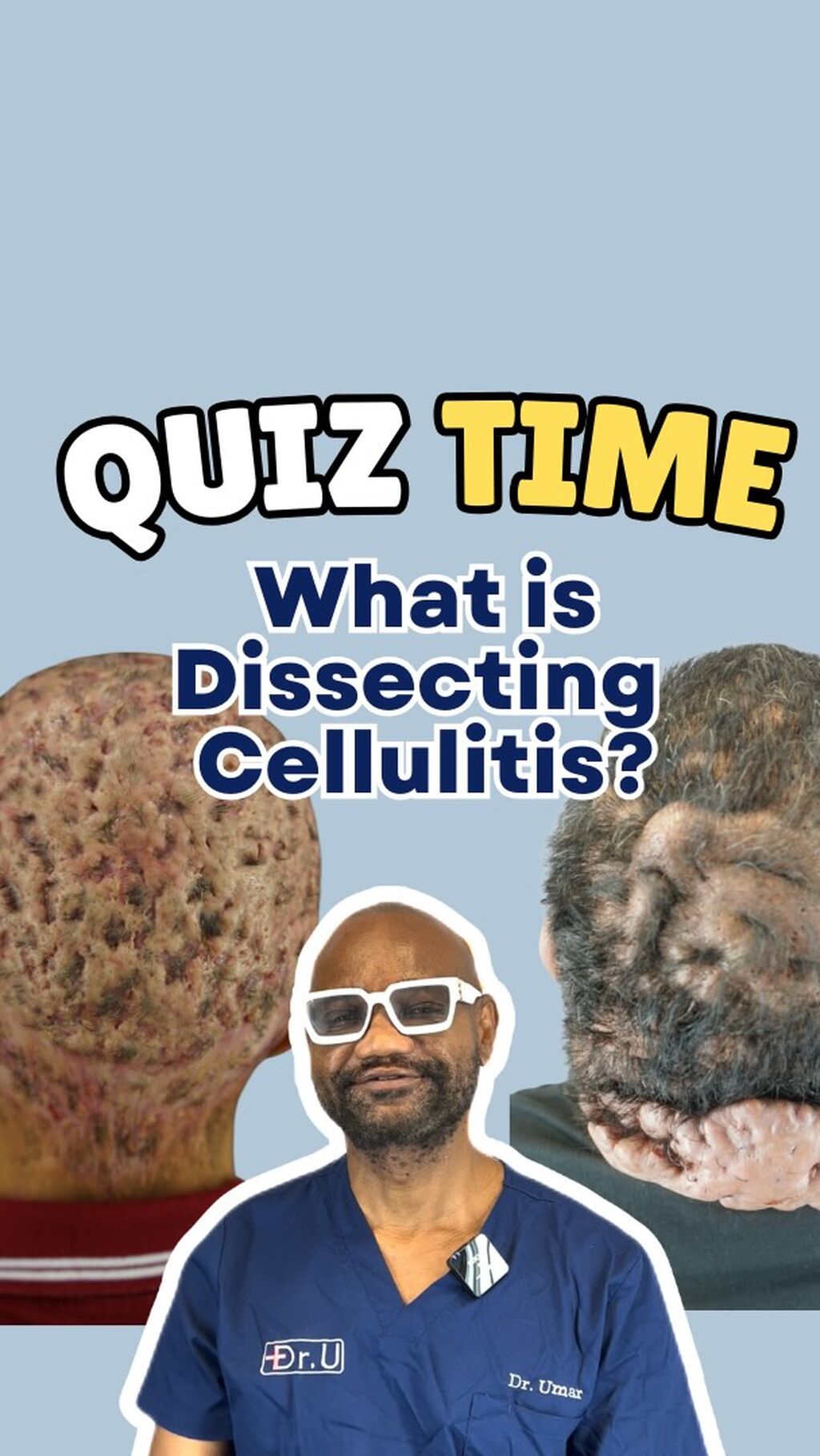 What is Dissecting Cellulitis?